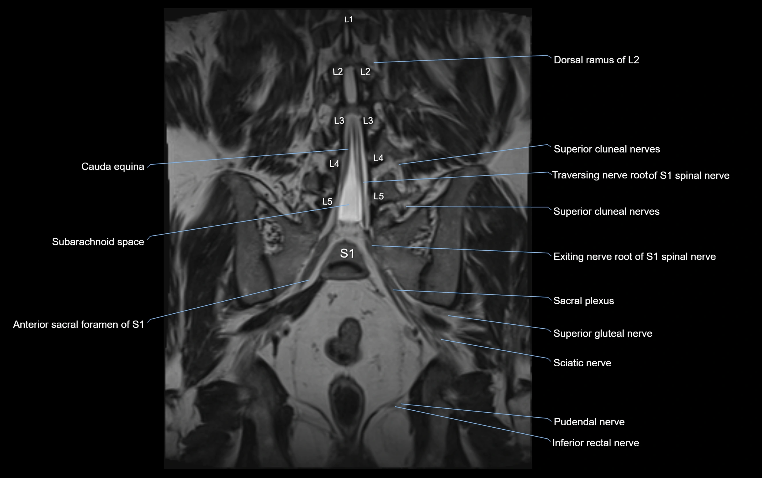 MR lumbosacral plexus cross sectional anatomy 3T  radiology  image-img-09001-00047.webp